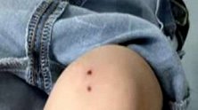 广东广州：铁衣叉从天而降！2岁男童膝盖被刺出两“窟窿”